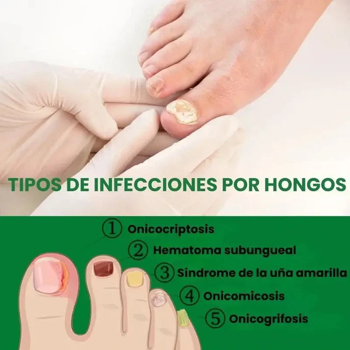 Fungixil® Original - elimina y previene el hongo de tus uñas
