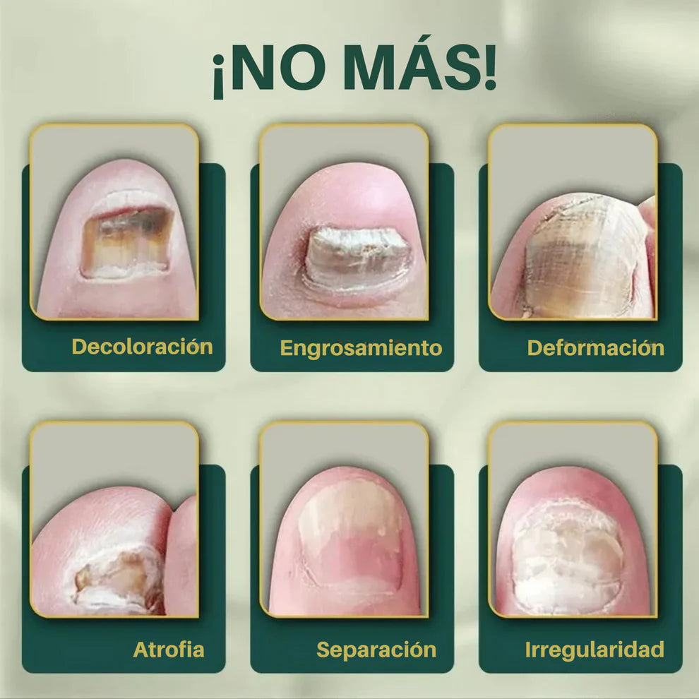 Fungixil® Original - elimina y previene el hongo de tus uñas